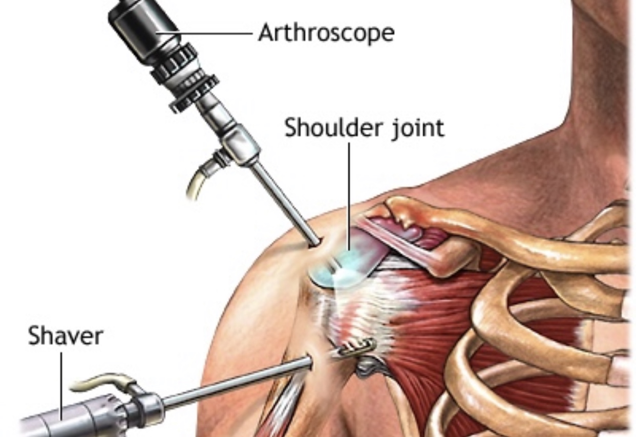 Do You Need Shoulder Surgery Core Omaha Explains C O R E Physical Therapy And Sports