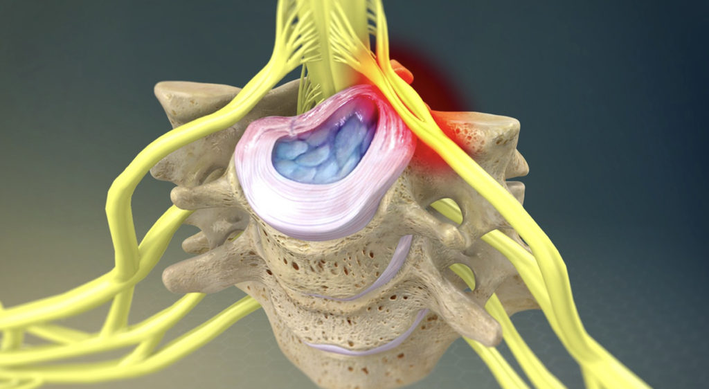 Lower Trap Needling in Neck Pain, CORE Omaha Explains... - C.O.R.E ...