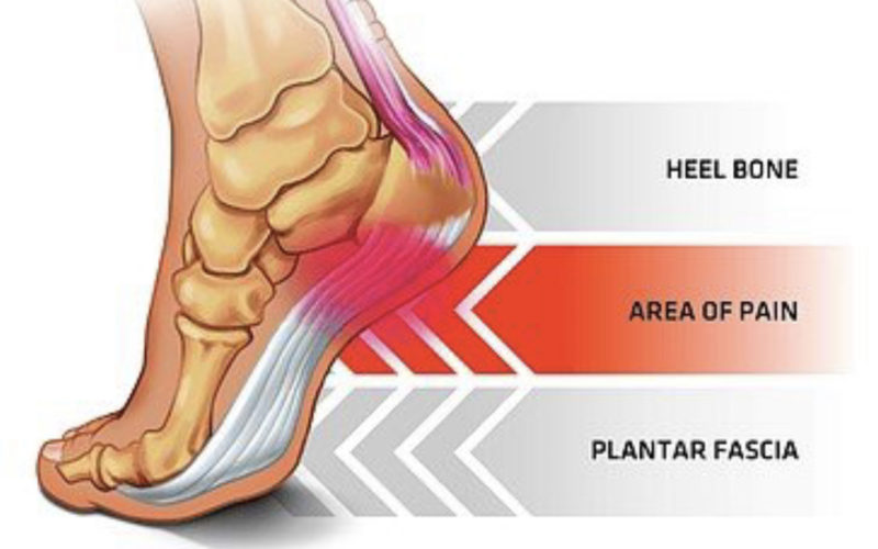 How Wide Is The Plantar Fascia