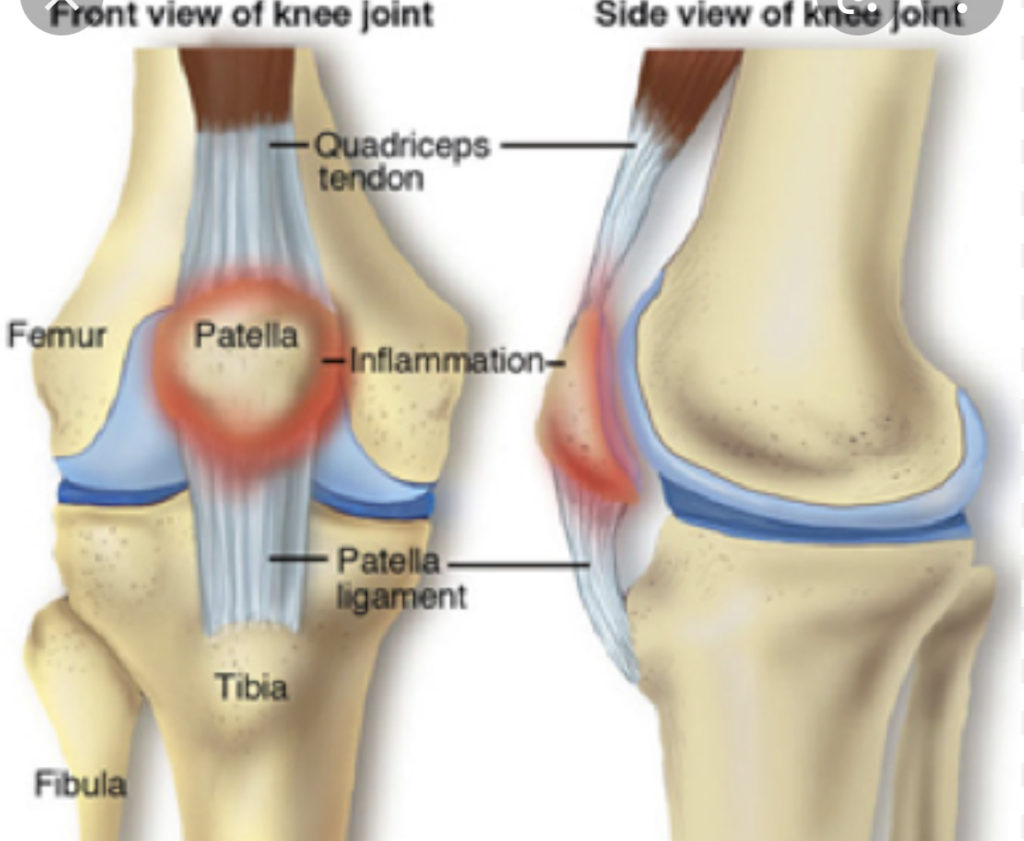 Пателлофеморальный артроз коленного сустава что это такое