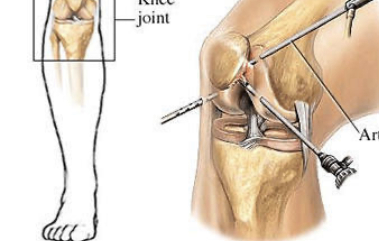 Артроскопия колена