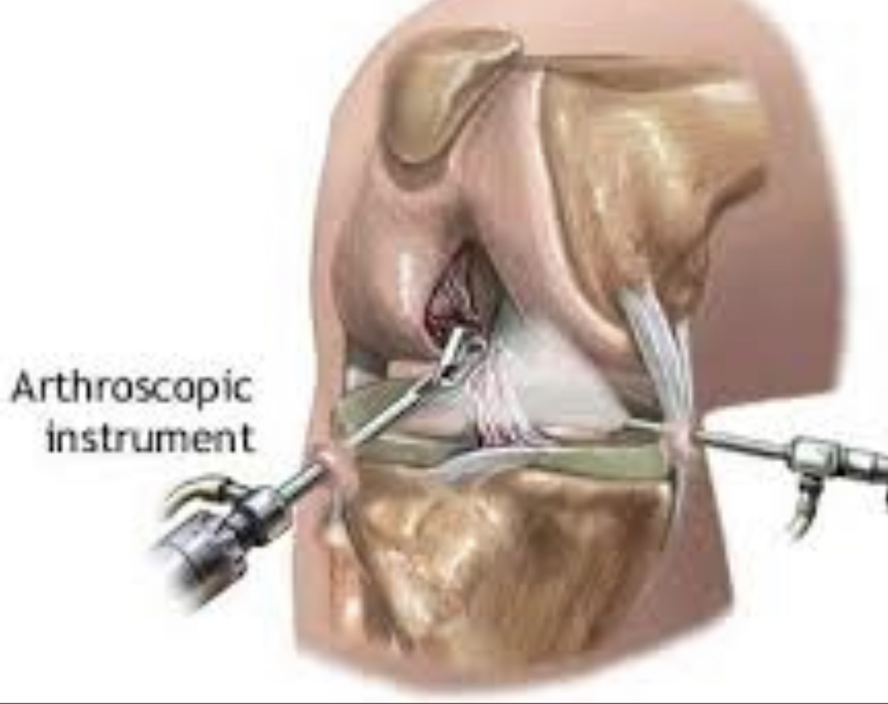 Оперативное лечение коленного сустава. Артроскопический дебридмент коленного сустава что это такое. Артроскопическая хирургия коленного сустава. Артроскопия дебридмент. Tibel menis.